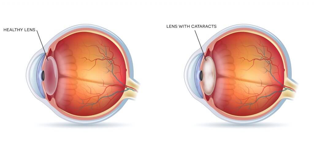 Diagram of cataracts