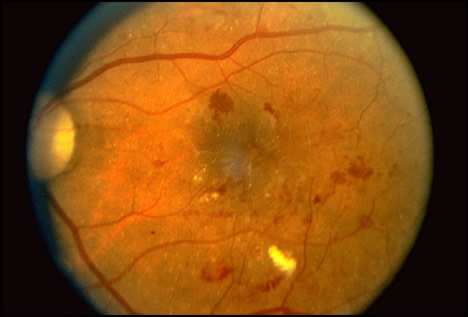 Diagram of diabetic retinopathy