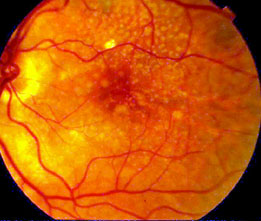 Macular degeneration