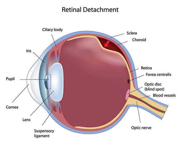 Diagram of retinal detachment